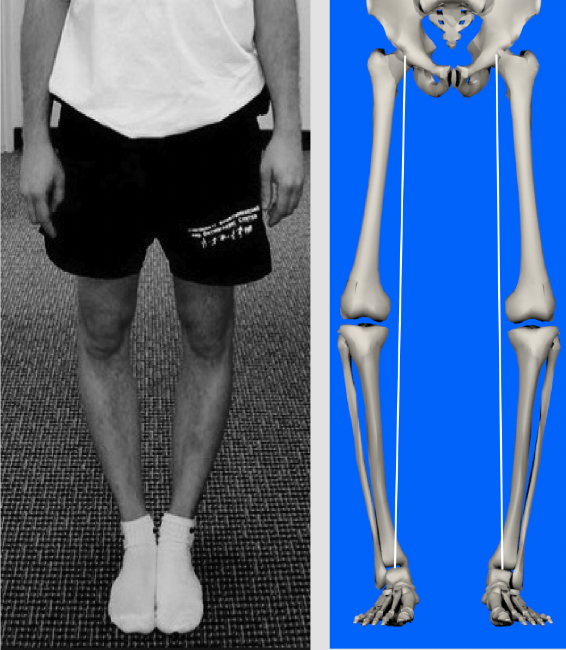 Functional alignment plan for knee replacement