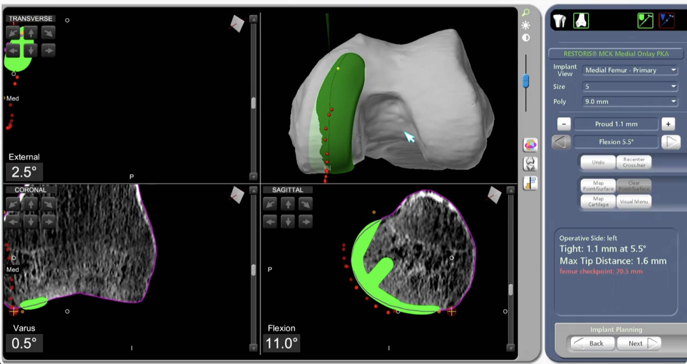 Mako CT-based 3D plan for total knee replacement